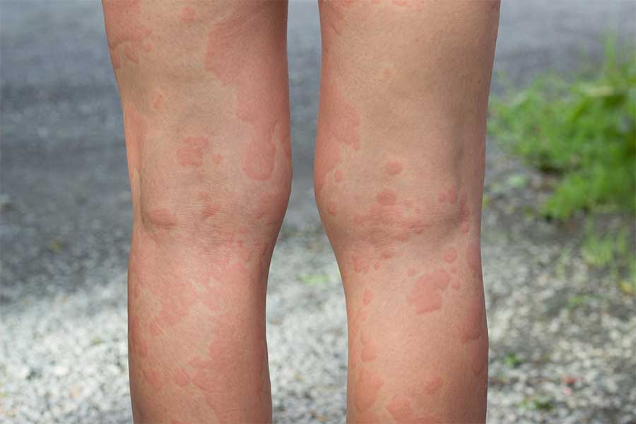 Allergische Erkrankungen - Allergiebehandlungen Salzburg
