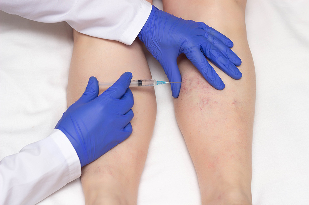 Verödung von Krampfadern und Besenreisern bei Dr. Michael Mandl - HAutarzt in Salzburg